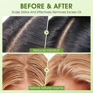 Before and after comparison showing reduction of dandruff and excess oil after using apple cider scalp scrub shampoo