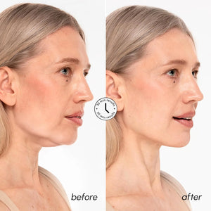 Before and after comparison of woman using MAREE Chin Lifting Mask showing visibly smoother jawline appearance.
