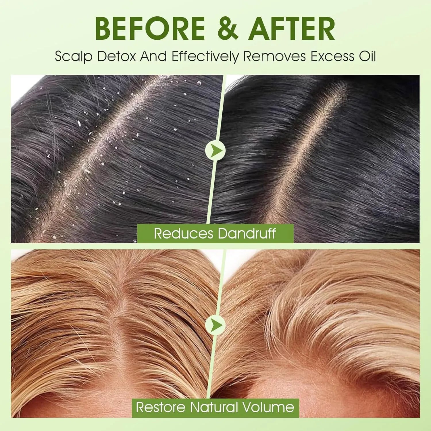 Before and after comparison showing reduction of dandruff and excess oil after using apple cider scalp scrub shampoo