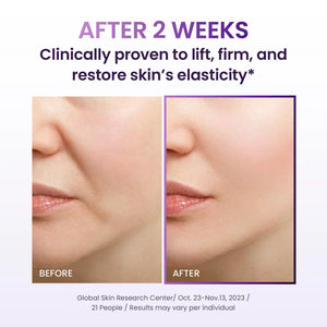 BIOHEAL BOH Probioderm 3D lifting cream before and after results