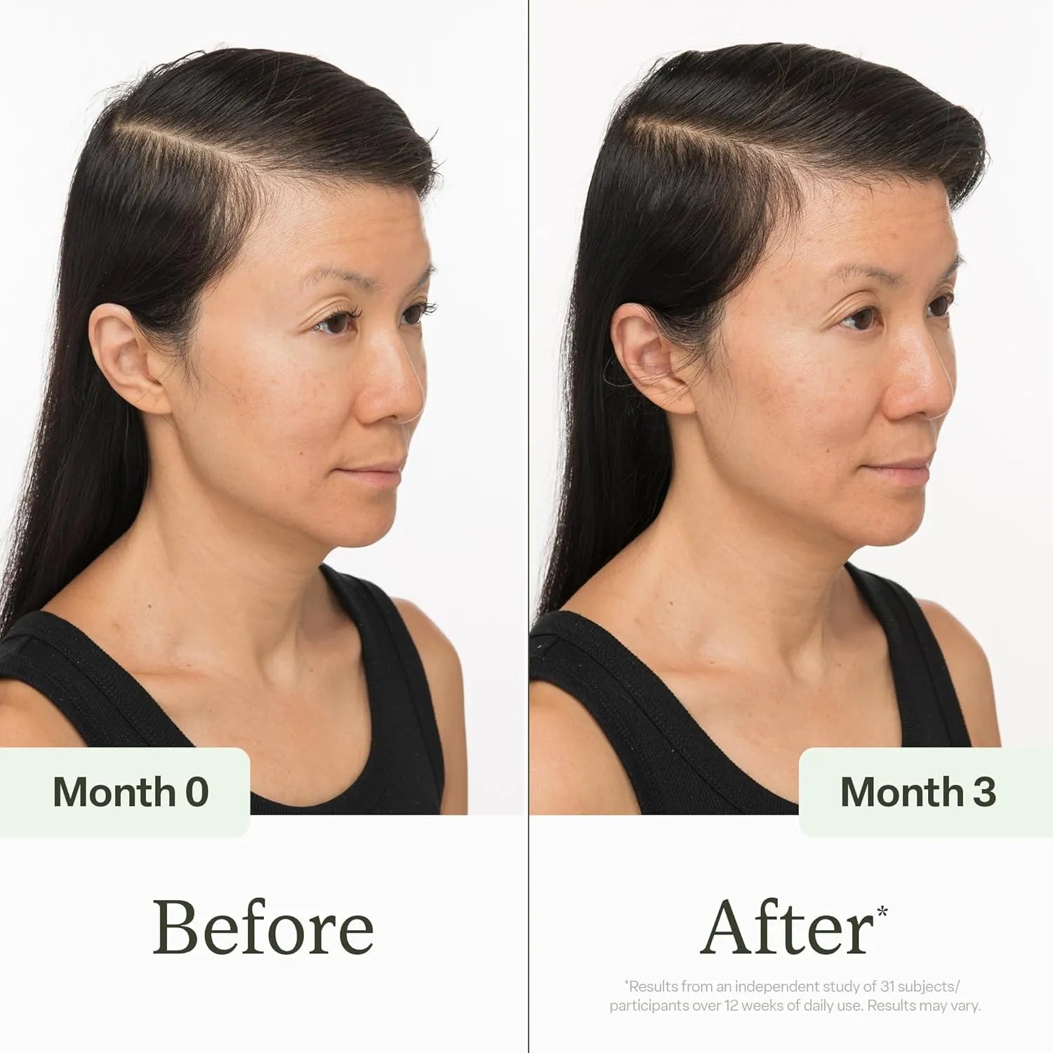 Before and after comparison of a woman's hairline over three months.