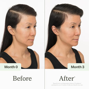 Before and after comparison of a woman's hairline over three months.