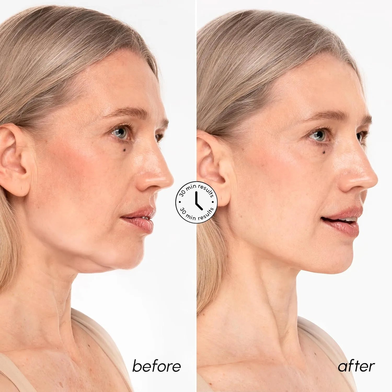 Before and after comparison of woman using MAREE Chin Lifting Mask showing visibly smoother jawline appearance.