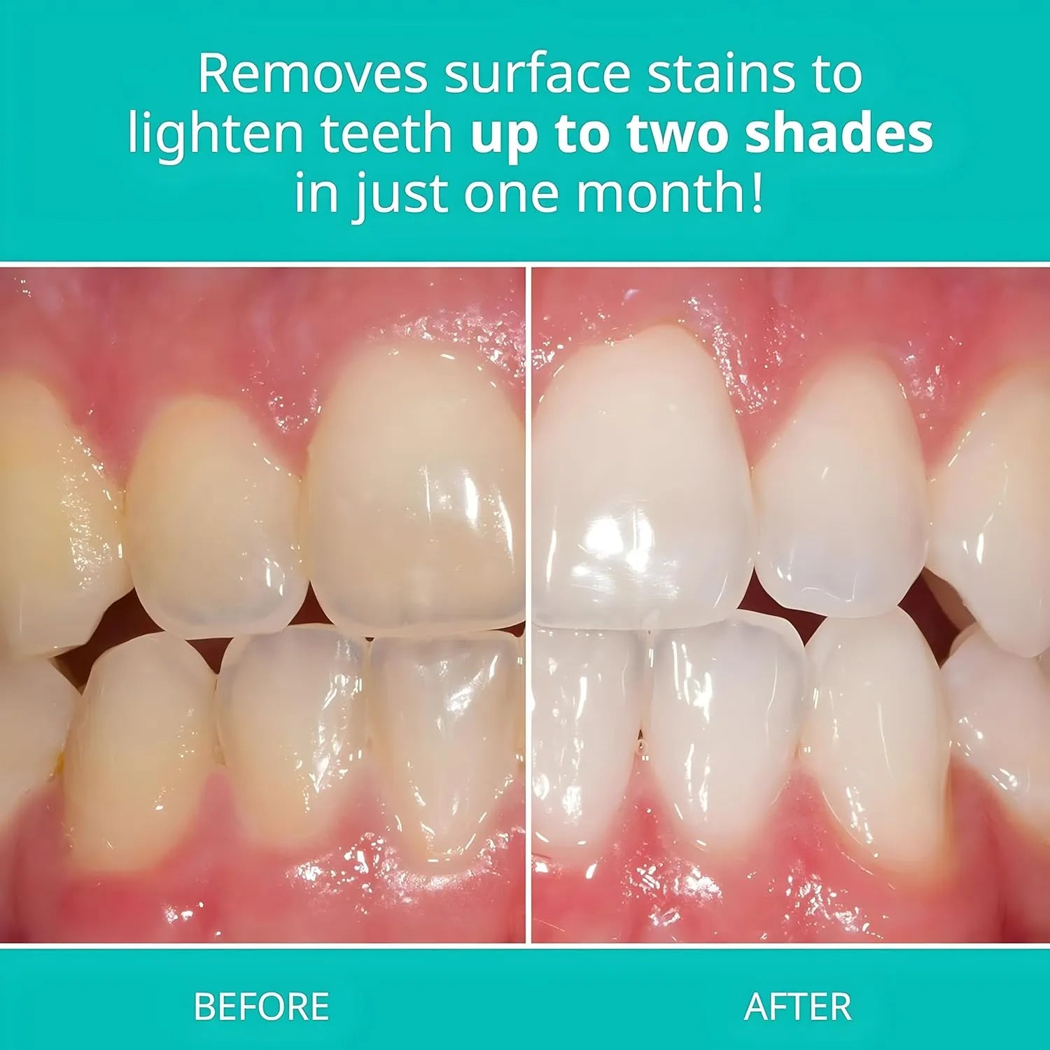 Before and after comparison of teeth showing surface stain improvement after using Opalescence Whitening Toothpaste.