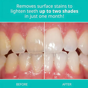 Before and after comparison of teeth showing surface stain improvement after using Opalescence Whitening Toothpaste.